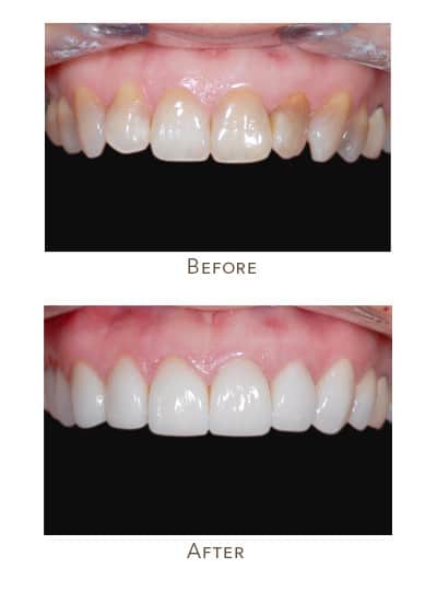 1738865472 discolored teeth