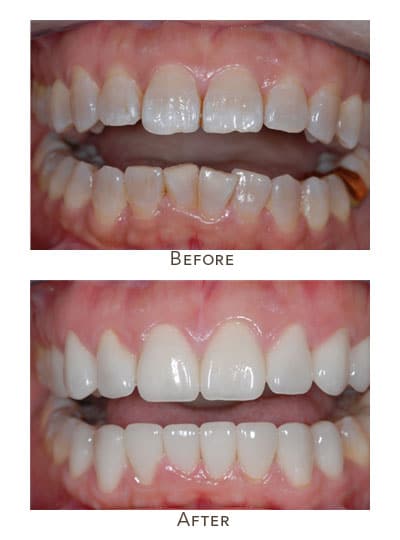 1738865479 tetracycline stain before after