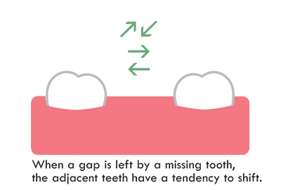 1738865494 no tooth causes other teeth to shift