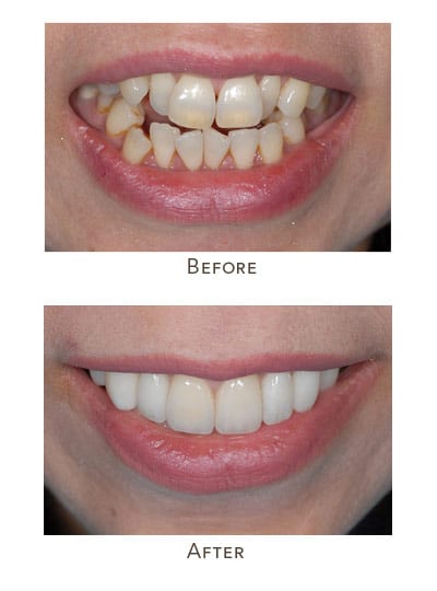 1738865573 crowded teeth