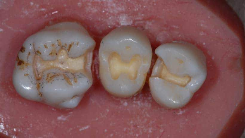 tooth preparation using the loupes