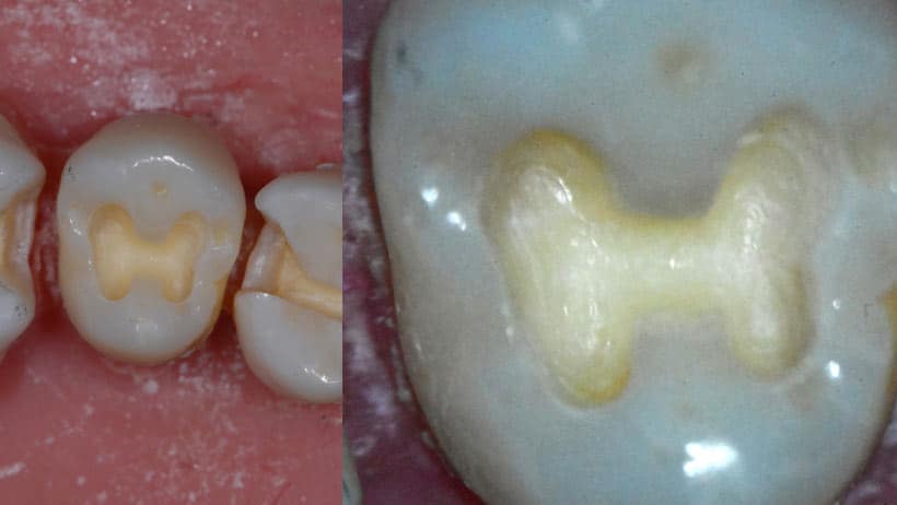 tooth preparation results using loupes and microscopes