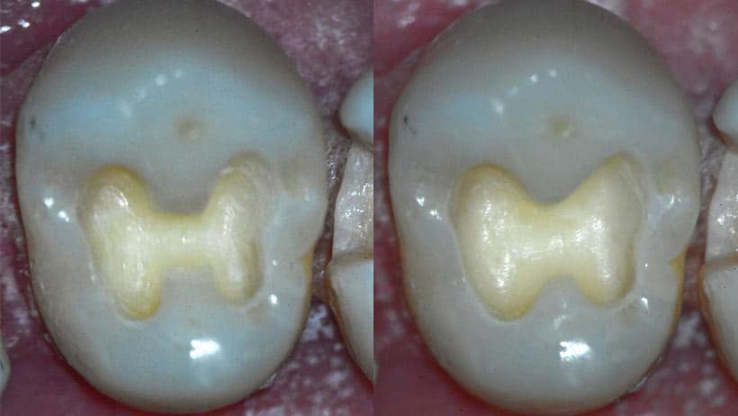 Tooth preparation results between loupes and microscope