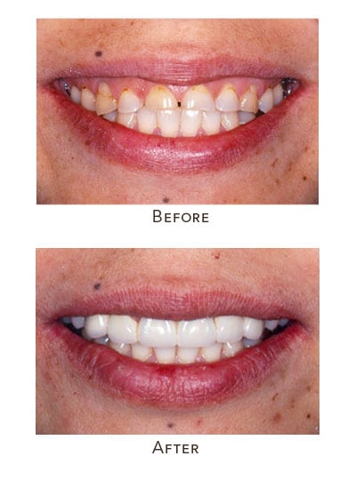1738865848 worn front teeth reconstruct 1