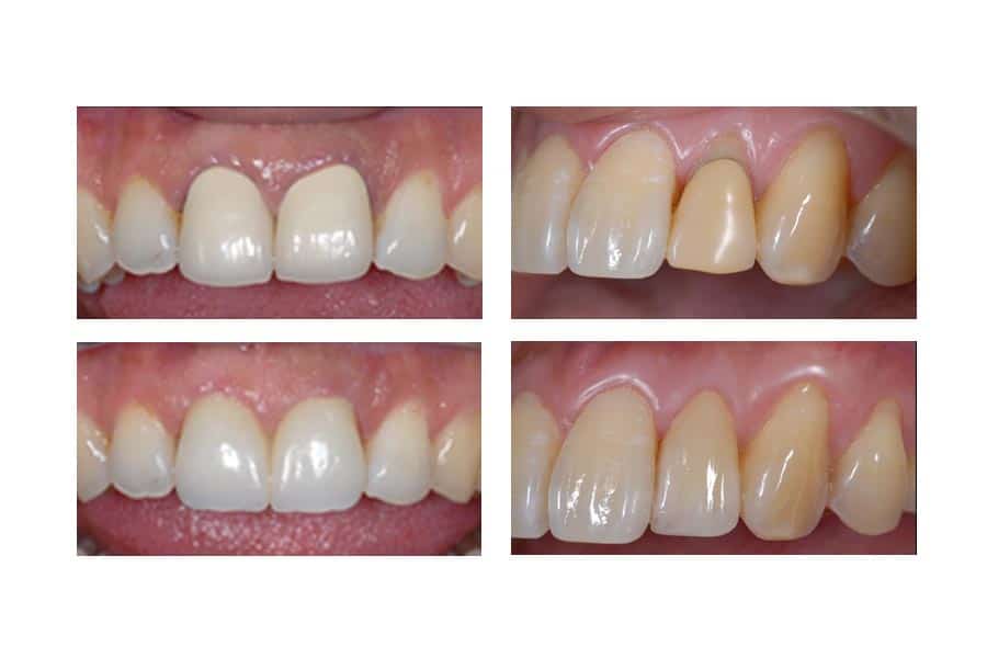 1738865859 tooth color restoration