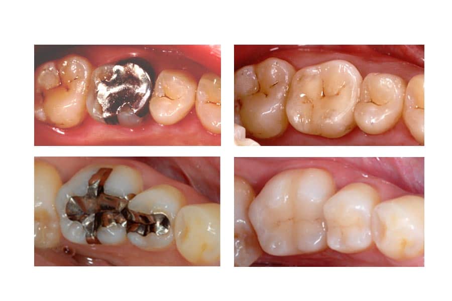 1738865865 remove amalgam fillings