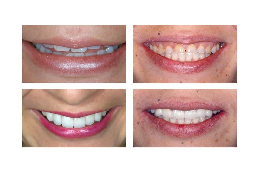1738865868 full mouth reconstruction beforeafter