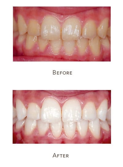 1738865878 teeth whitening before after