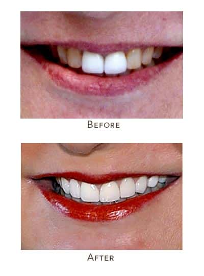 1738865886 uneven teeth color repair