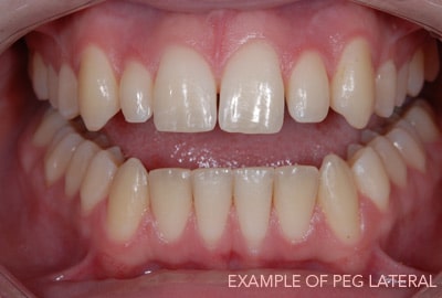 1738865907 peg lateral case 1
