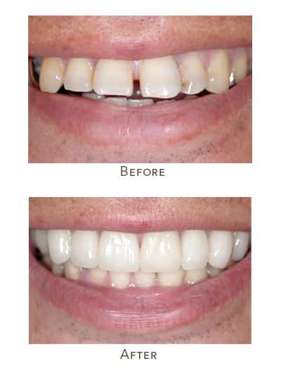 1738865911 flared teeth before and after 1