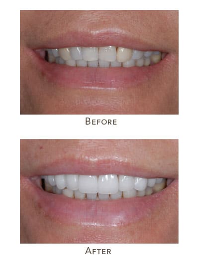 asymmetrical front upper teeth colors