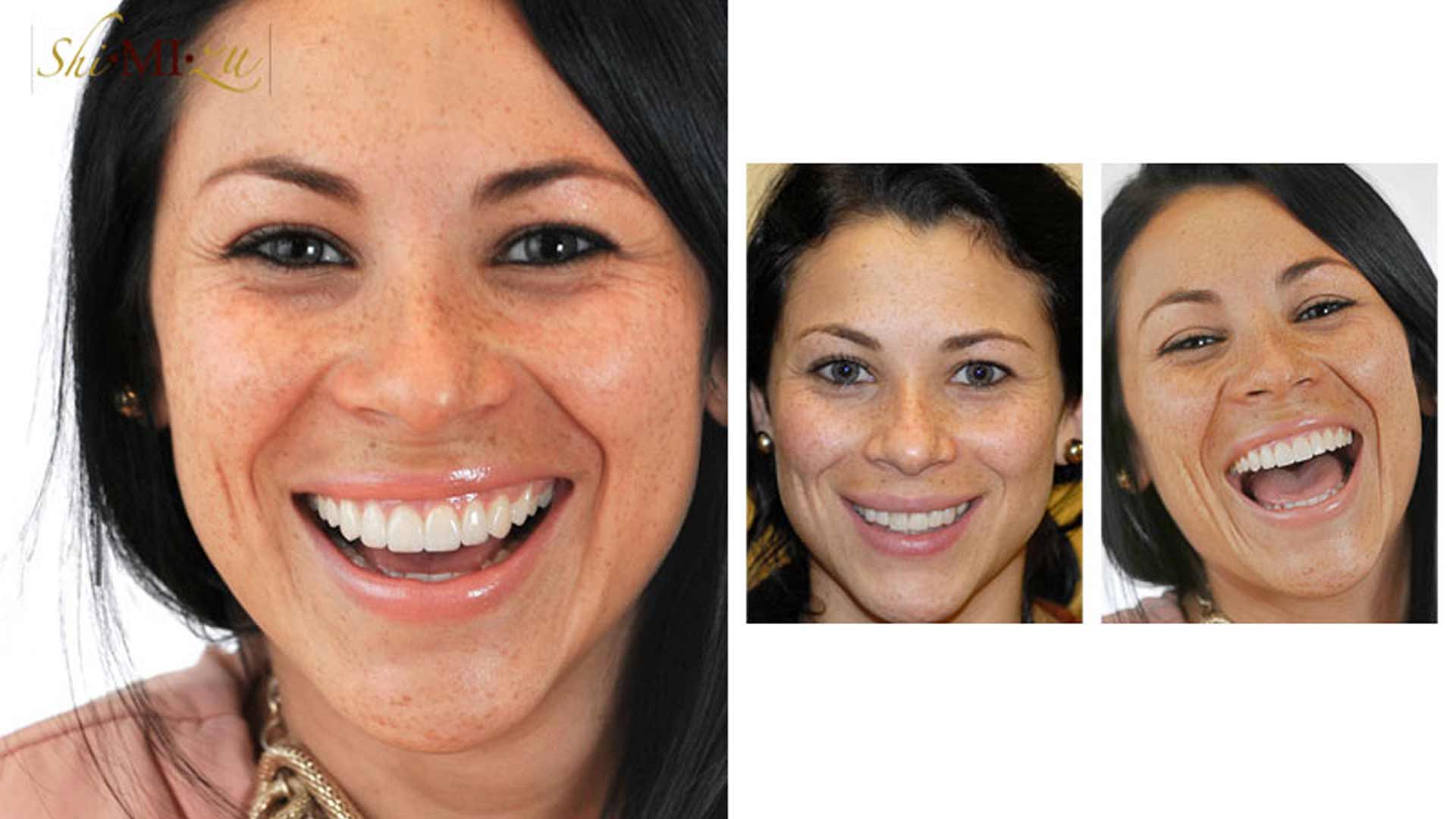 chipped front teeth