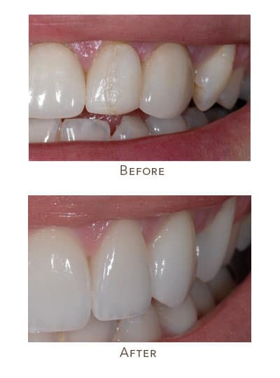cracked veneers closeup