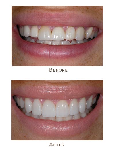 cracked veneers