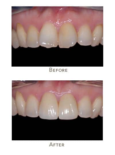 crooked incisors