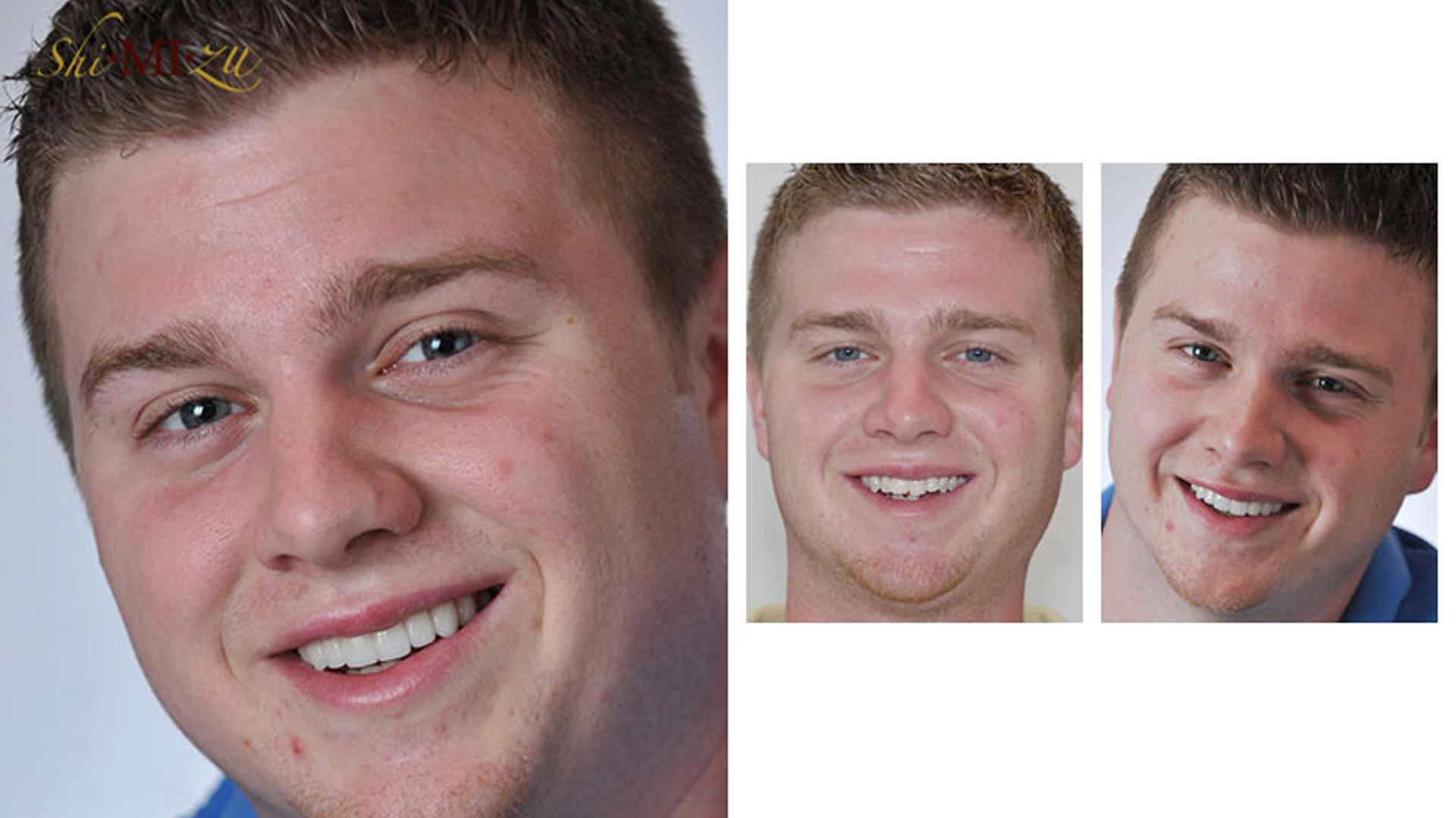 crooked to straight teeth in less time
