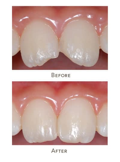 dental bonding child before after