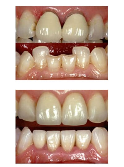 dental crown like natural teeth