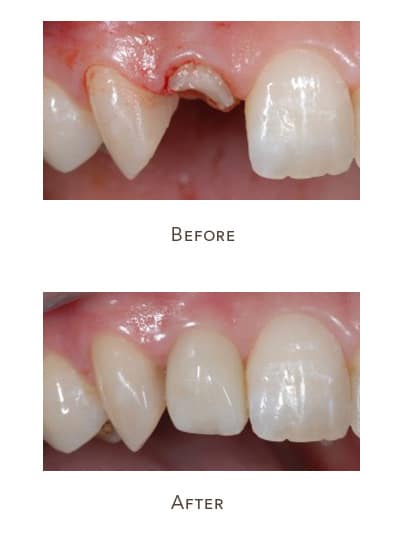dental implant before after