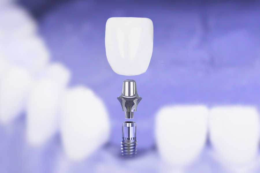 dental implant