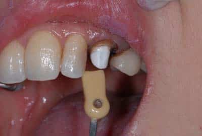 dental post composite