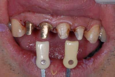 dental post gold