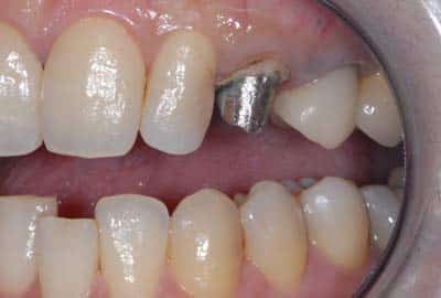 dental post silver