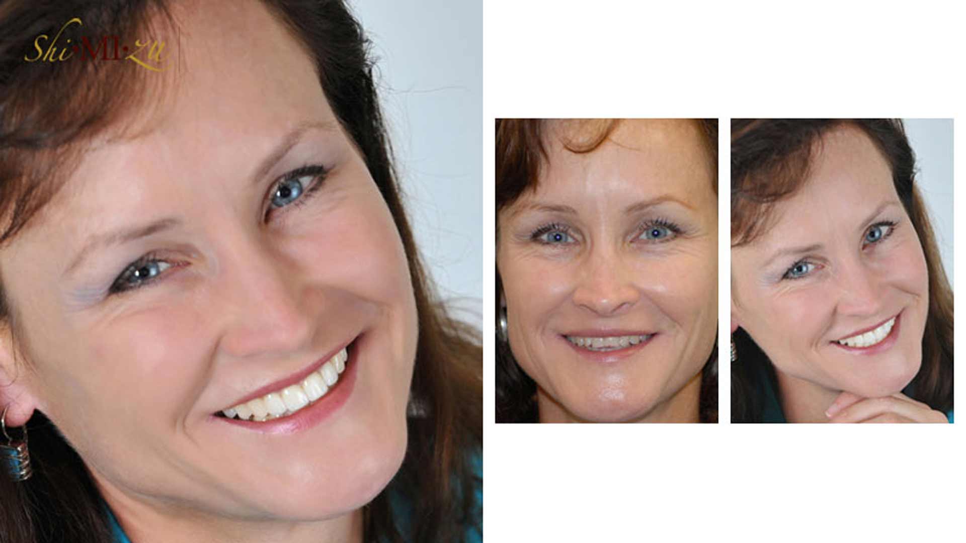 discolored teeth fix