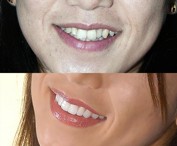 fix crooked teeth 580x480