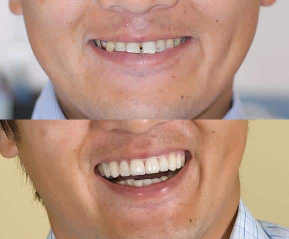fix flared teeth 580x480