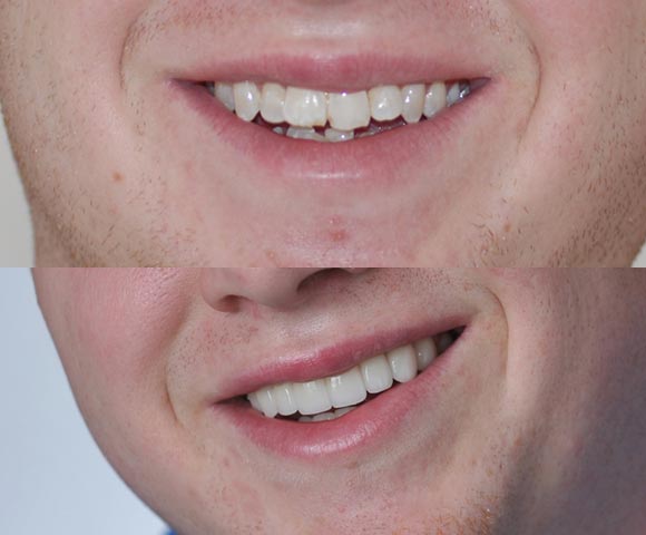fix overlapping front teeth 580x480