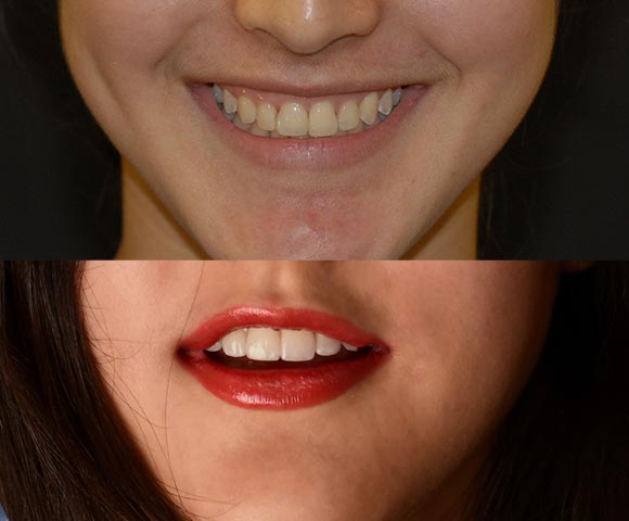 fix short teeth 580x480
