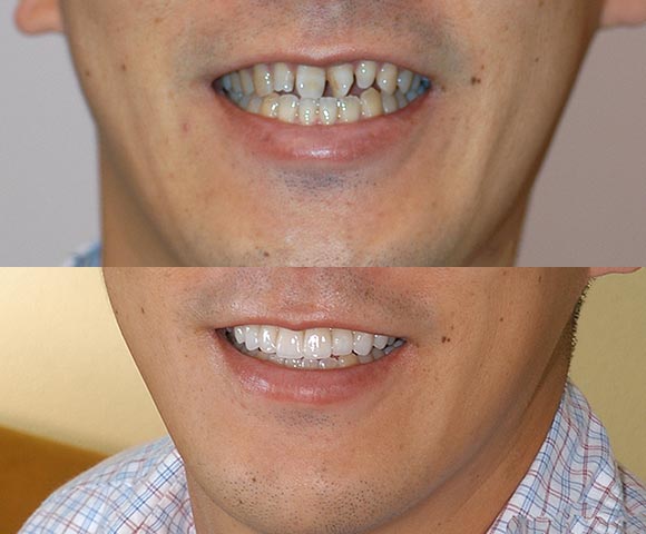 fix small rotated teeth 580x480