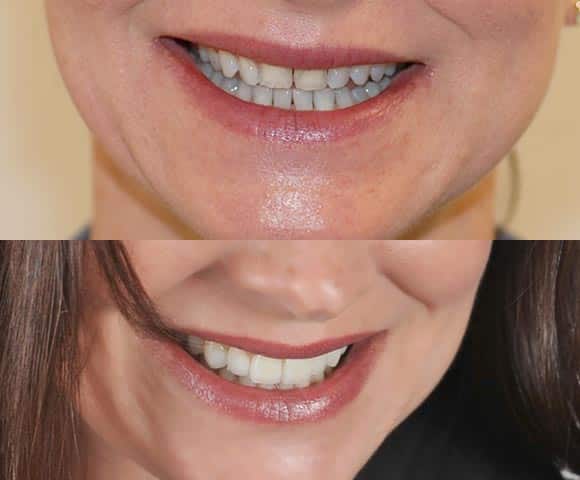 fix small teeth 580x480