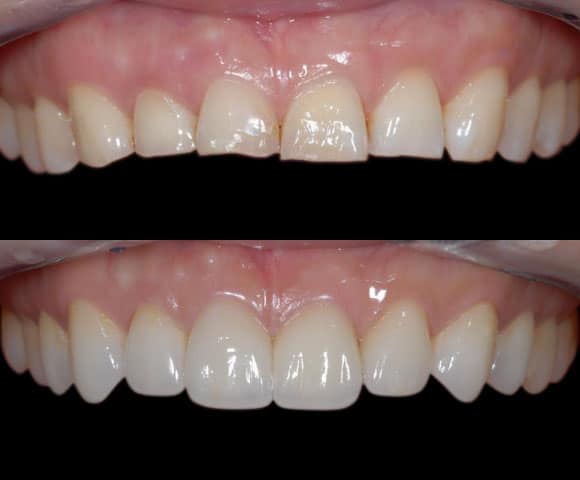 fix uneven teeth length 580x480