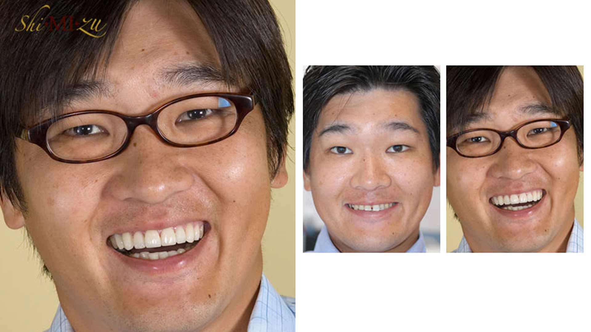 flared teeth fix no braces