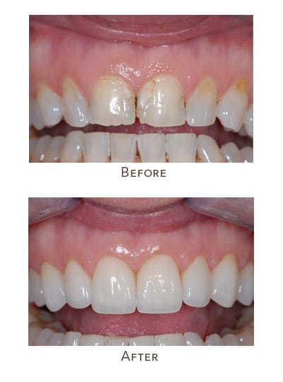 front teeth uneven surface