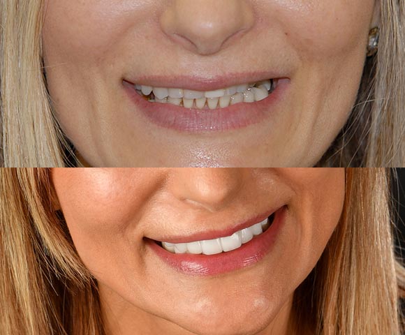 full dental reconstruction 580x480