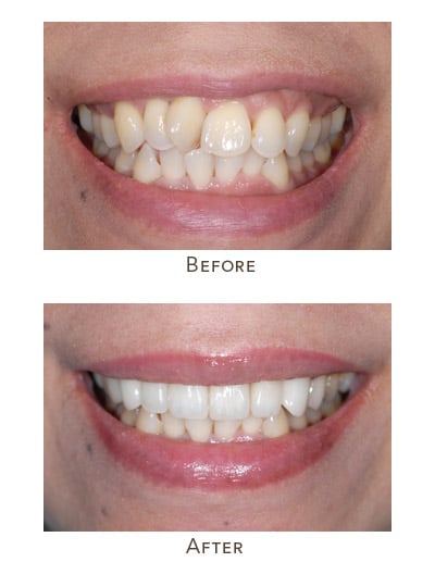 instant orthodontics