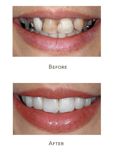 messed up teeth fix with veneers