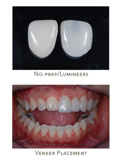 no prep veneers placement