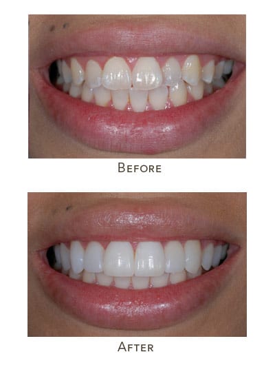 no prep veneers upper teeth