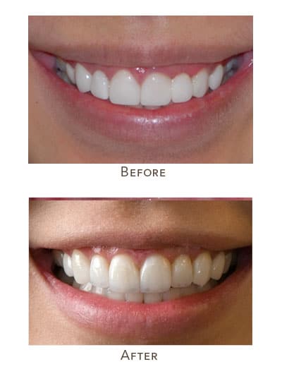 no prep veneers vs porcelain veneers