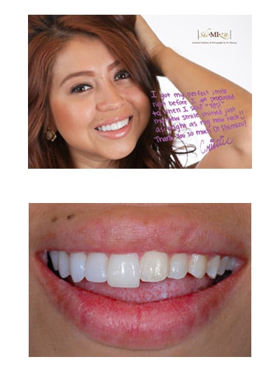 no prep veneers