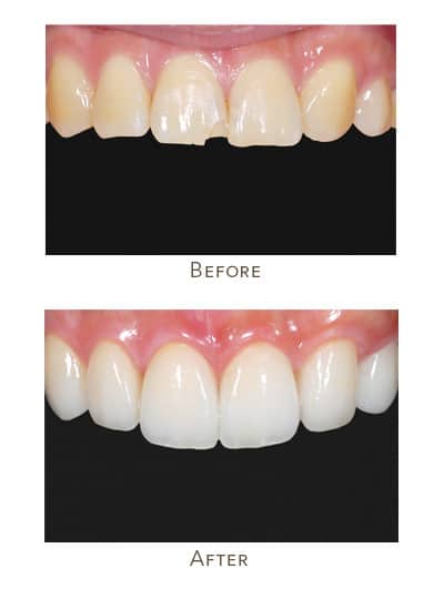 porcelain veneers before after