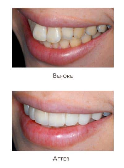 protruding teeth