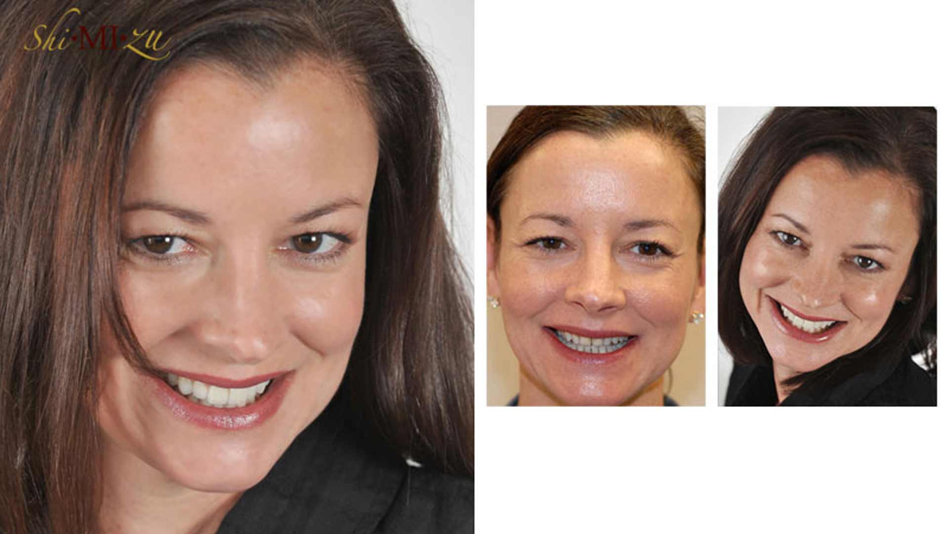 short front teeth fix