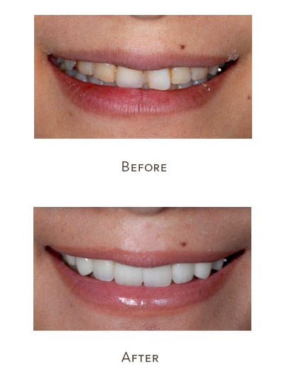 straighten teeth with veneers