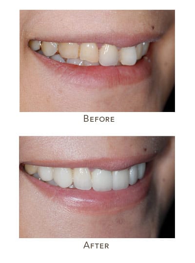 straighten teeth without having braces